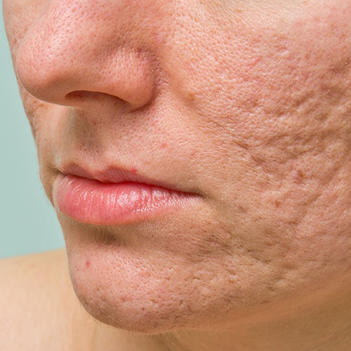 acne-scars-asian