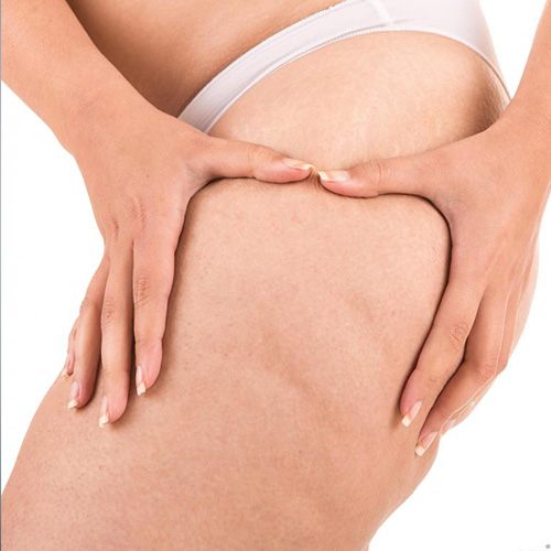 limclinic-and-surgery-cellulite-trreatment
